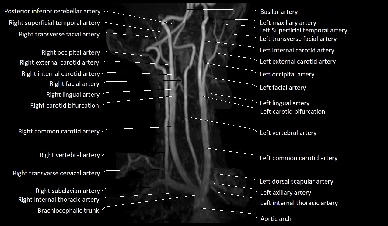 MRA neck carotid arteries labeled anatomy image MIP 3D image 9.webp